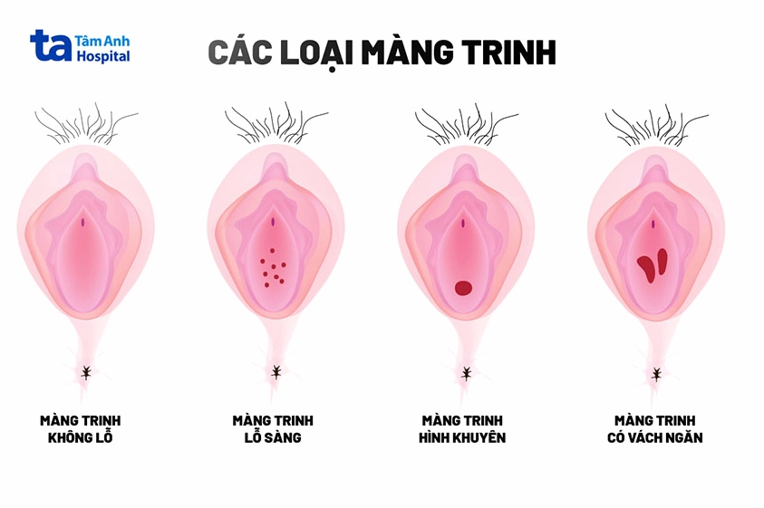 Các hình dạng đa dạng của màng trinh ở phụ nữ