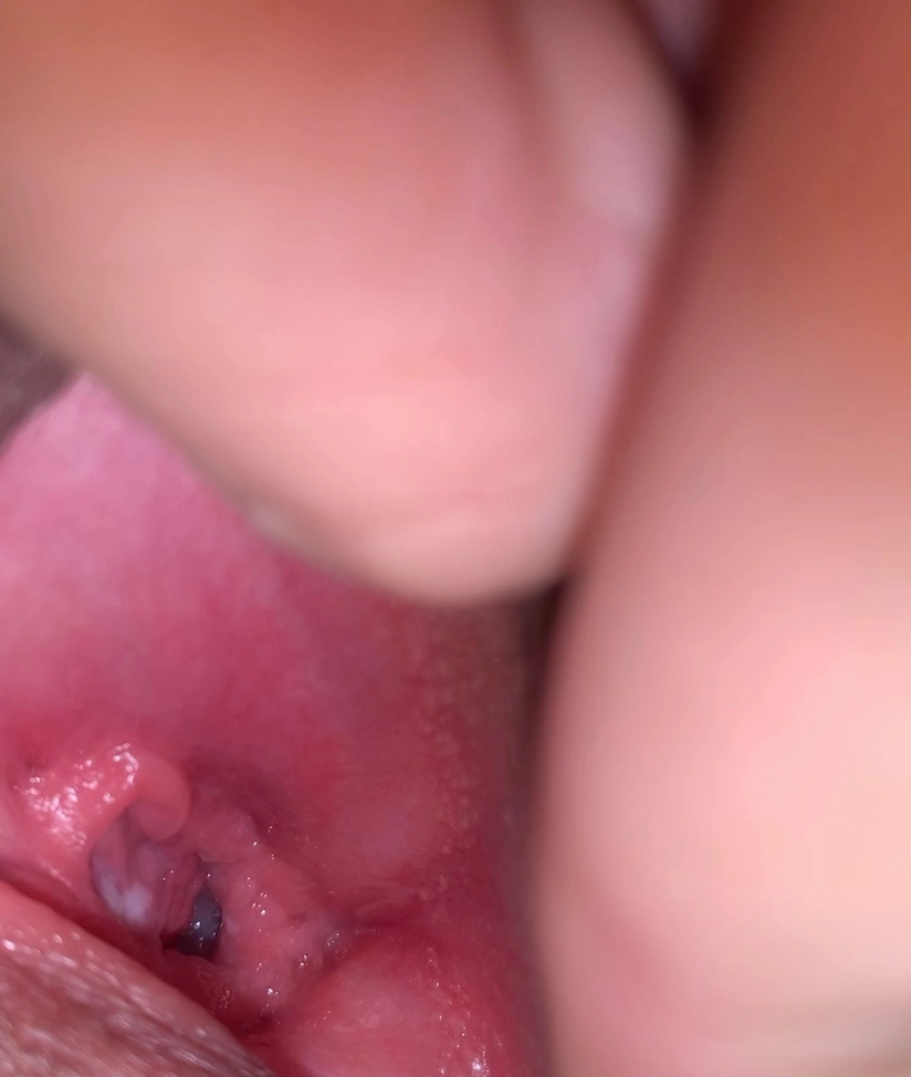 Giải phẫu màng trinh với lỗ thoát tự nhiên