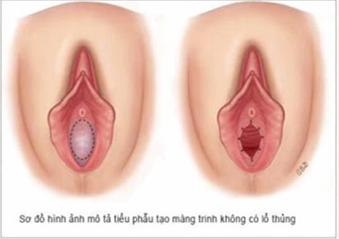 Hình ảnh giải phẫu màng trinh nằm ở cửa âm đạo