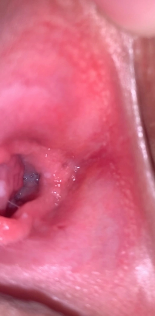 Hình ảnh minh họa một dạng màng trinh có thể co giãn